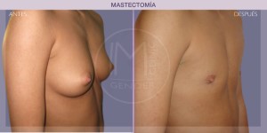 Before and after pictures of mastectomy treatment